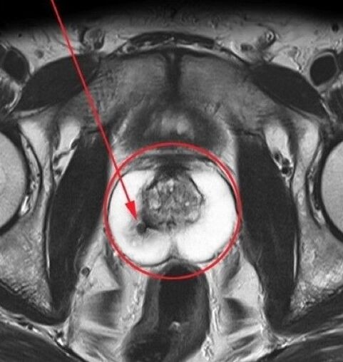 Zapalenie prostaty do ultradźwięków przed przyjęciem UROSAF