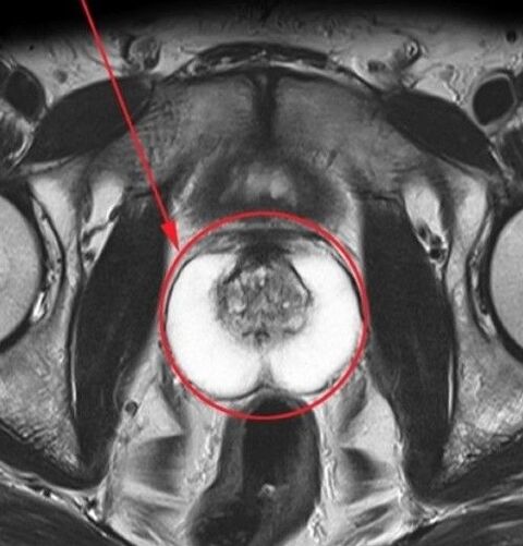 Zdrowa prostata do ultradźwięków po przyjęciu Uroosaf
