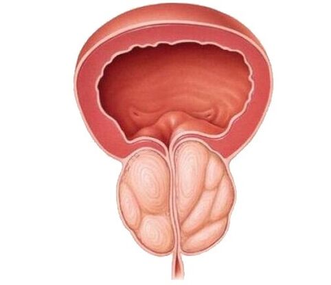 Zwiększone prostaty i leczenie kapsułkami UROSAF