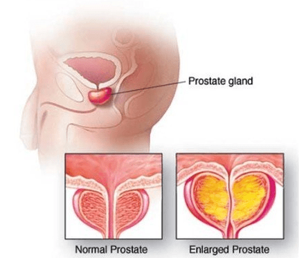 Normalna i zapalna prostata